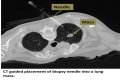 How do you feel after a lung biopsy?