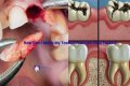 How long does it take for a molar extraction to heal?